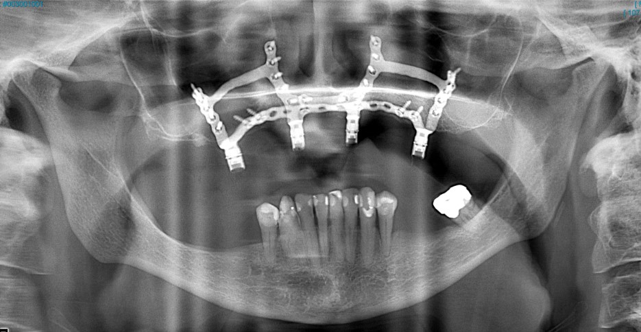 An x-ray image of the OsseoFrame implanted in a patient. The OsseoFrame stick out as metal bars aligned with the top gum of the patient.
