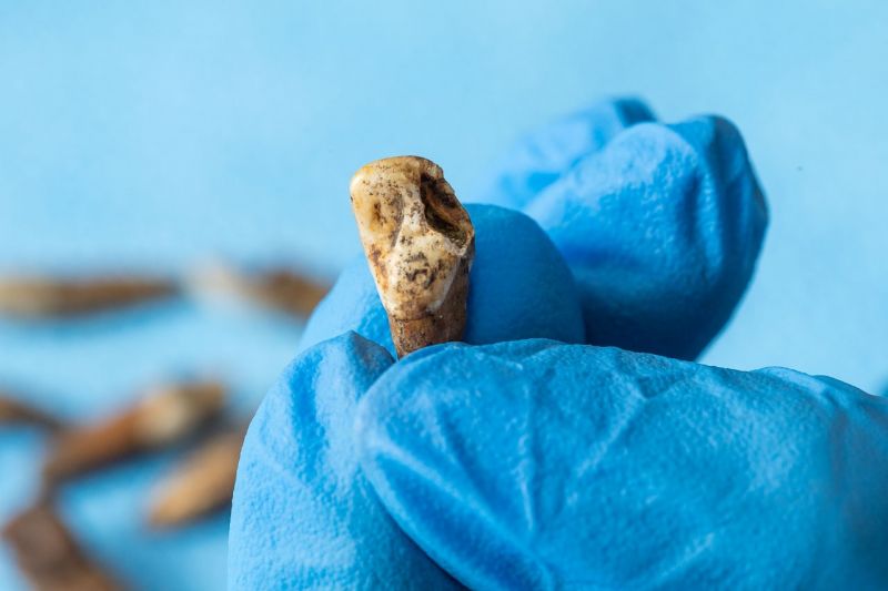 Close-up of a tooth from the 19th Century with a large cavity being held by a gloved hand